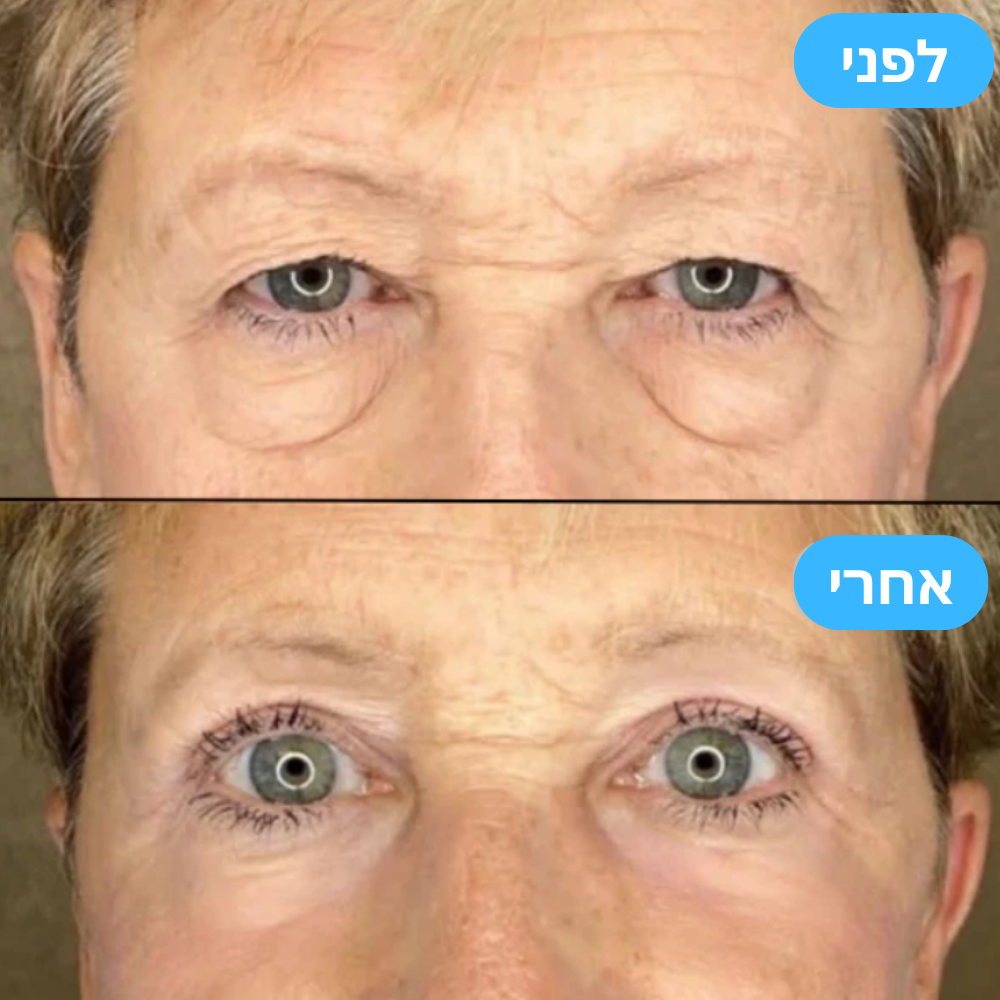 Fixed Glow™ - מדבקות להעלמת קמטים ושקיות בעיניים